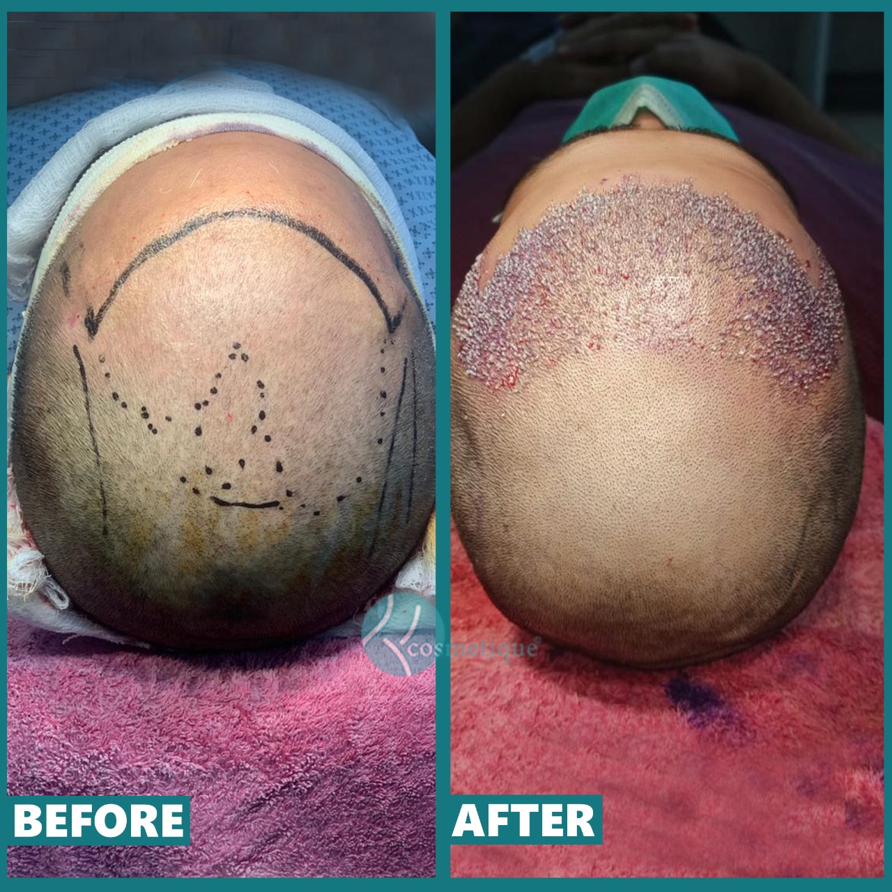 Hair-Transplant-Surgery-in-Lahoreclinic.jpeg