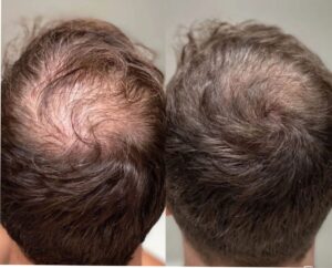 Hair transplant consultation for natural-looking hair restoration