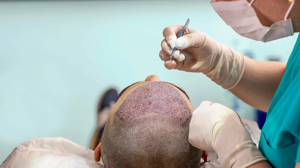 Hair transplant recovery process for diabetes patients